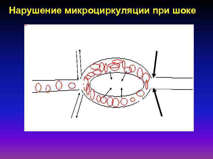 Нарушение микроциркуляции при шоке 