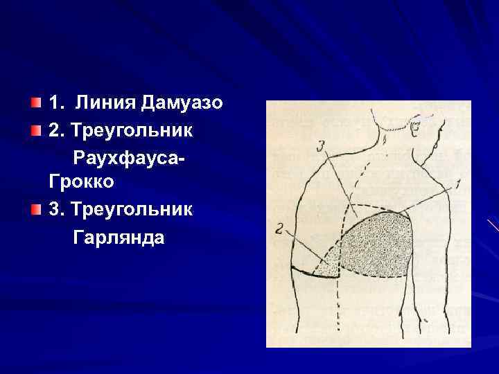 1. Линия Дамуазо 2. Треугольник Раухфауса Грокко 3. Треугольник Гарлянда 