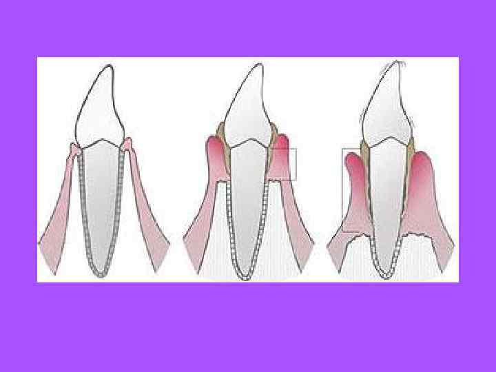   Согласно теории непрерывного пассивного прорезывания зуба, первоначально предложенной Готтлибом, прорезывание зубов продолжается