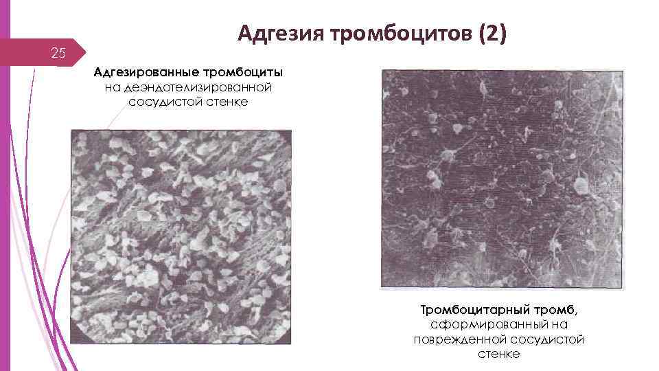 25 Адгезия тромбоцитов (2) Адгезированные тромбоциты на деэндотелизированной сосудистой стенке Тромбоцитарный тромб, сформированный на