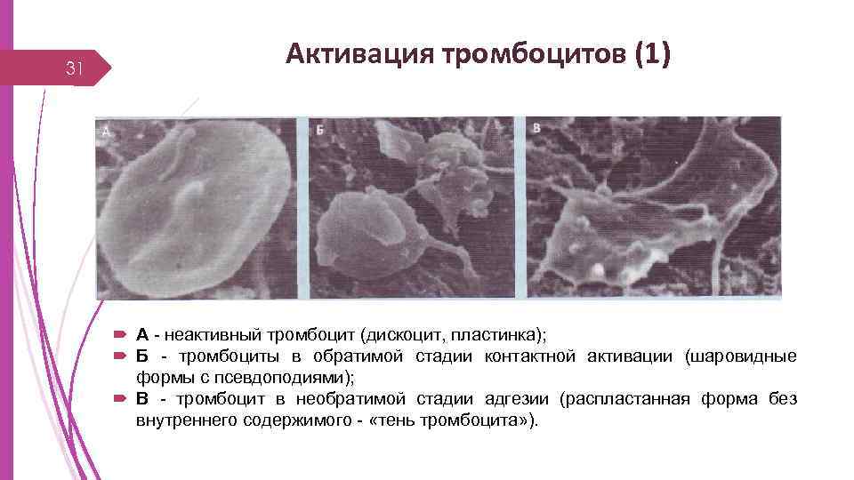 31 Активация тромбоцитов (1) А - неактивный тромбоцит (дискоцит, пластинка); Б - тромбоциты в