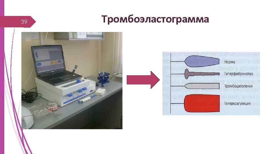 39 Тромбоэластограмма 