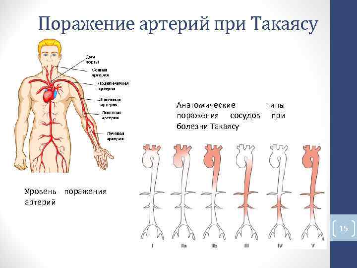 Поражение артерий при Такаясу Анатомические типы поражения сосудов при болезни Такаясу Уровень поражения Поражение артерий при Такаясу Анатомические типы поражения сосудов при болезни Такаясу Уровень поражения