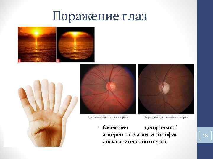 Поражение глаз • Окклюзия центральной артерии сетчатки и атрофия 18 диска зрительного нерва. Поражение глаз • Окклюзия центральной артерии сетчатки и атрофия 18 диска зрительного нерва.