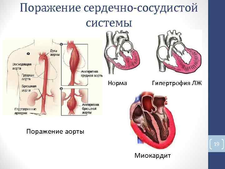 Поражение сердечно-сосудистой системы Норма Гипертрофия ЛЖ Поражение аорты 19 Миокардит Поражение сердечно-сосудистой системы Норма Гипертрофия ЛЖ Поражение аорты 19 Миокардит