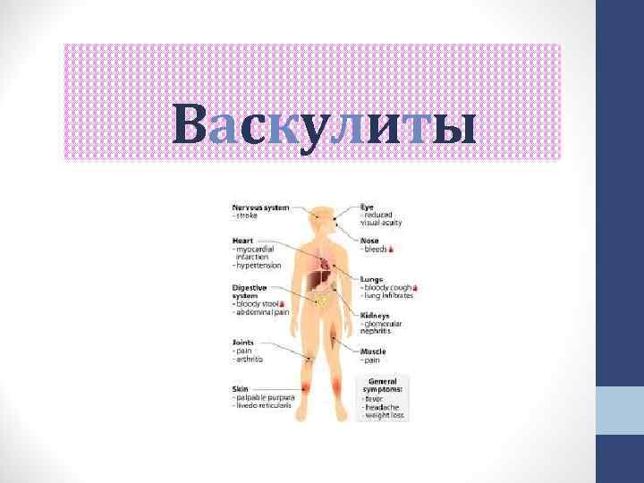 Васкулиты Васкулиты