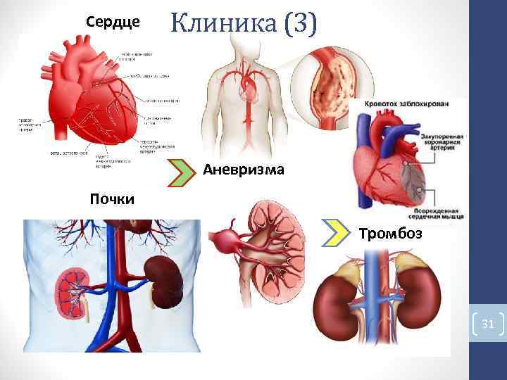 Сердце Клиника (3) Аневризма Почки Тромбоз 31 Сердце Клиника (3) Аневризма Почки Тромбоз 31