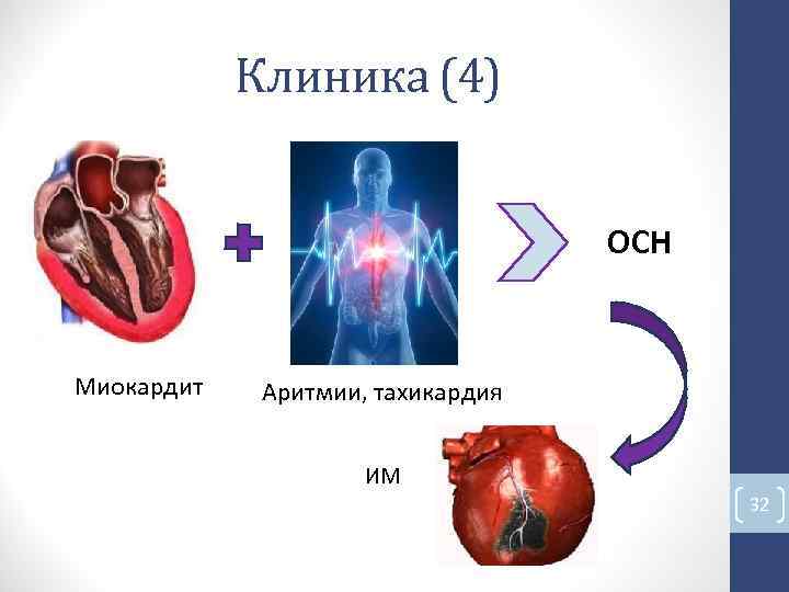 Клиника (4) ОСН Миокардит Аритмии, тахикардия ИМ 32 Клиника (4) ОСН Миокардит Аритмии, тахикардия ИМ 32
