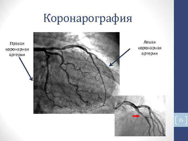 Коронарография Правая Левая коронарная артерия 35 Коронарография Правая Левая коронарная артерия 35
