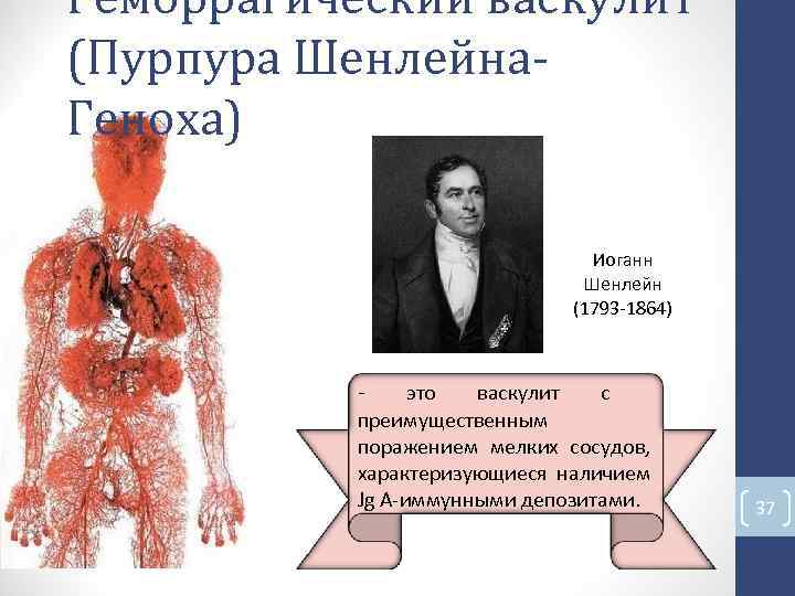 Геморрагический васкулит (Пурпура Шенлейна- Геноха) Иоганн Шенлейн (1793 -1864) - это васкулит с преимущественным Геморрагический васкулит (Пурпура Шенлейна- Геноха) Иоганн Шенлейн (1793 -1864) - это васкулит с преимущественным