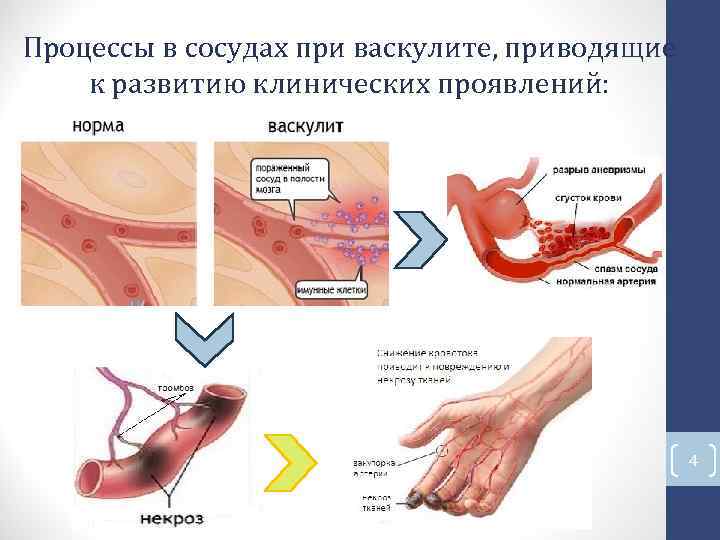 Процессы в сосудах при васкулите, приводящие к развитию клинических проявлений: 4 Процессы в сосудах при васкулите, приводящие к развитию клинических проявлений: 4