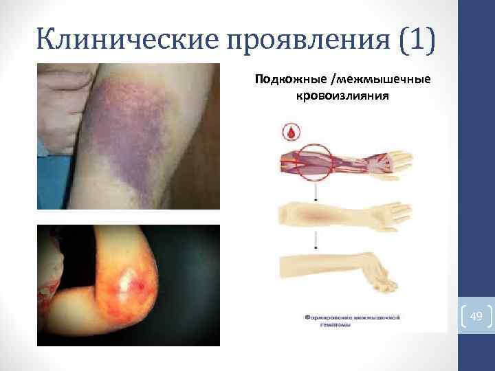 Клинические проявления (1) Подкожные /межмышечные кровоизлияния 49 Клинические проявления (1) Подкожные /межмышечные кровоизлияния 49