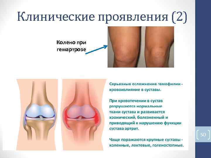 Клинические проявления (2) Колено при гемартрозе 50 Клинические проявления (2) Колено при гемартрозе 50