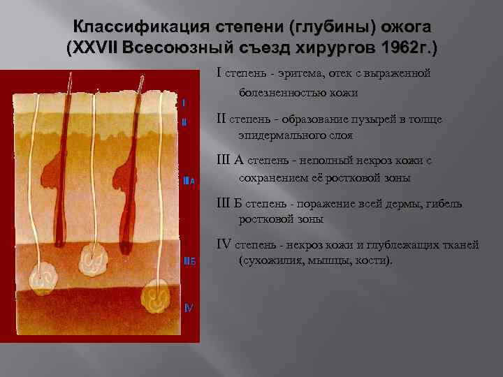 Классификация степени (глубины) ожога (XXVII Всесоюзный съезд хирургов 1962 г. ) I степень -