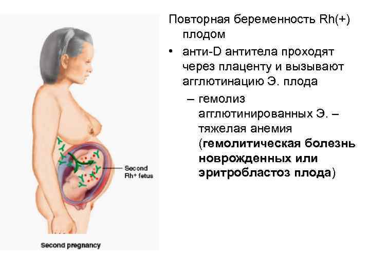 Повторная беременность Rh(+) плодом • анти-D антитела проходят через плаценту и вызывают агглютинацию Э.
