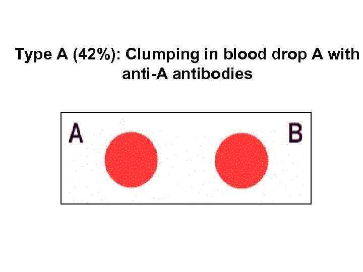 Type A (42%): Clumping in blood drop A with anti-A antibodies 