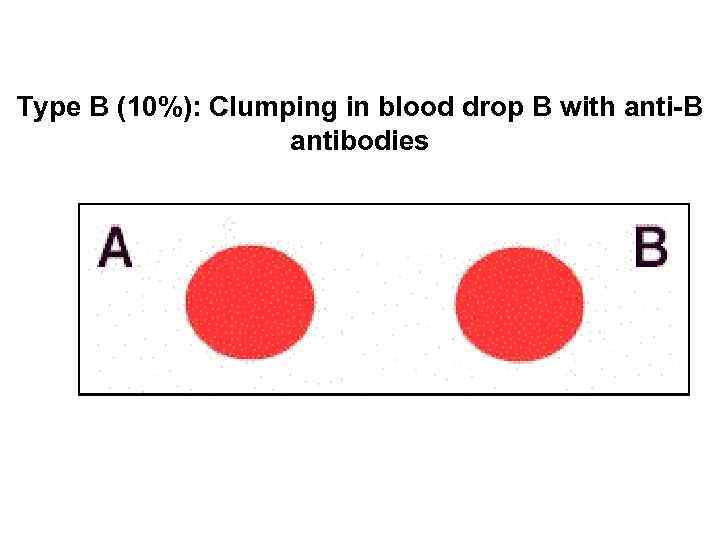 Type B (10%): Clumping in blood drop B with anti-B antibodies 