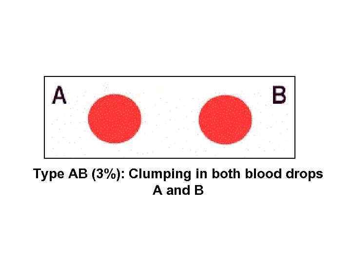 Type AB (3%): Clumping in both blood drops A and B 
