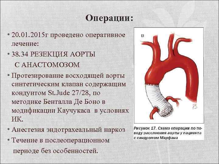 Операции: • 20. 01. 2015 г проведено оперативное лечение: • 38. 34 РЕЗЕКЦИЯ АОРТЫ