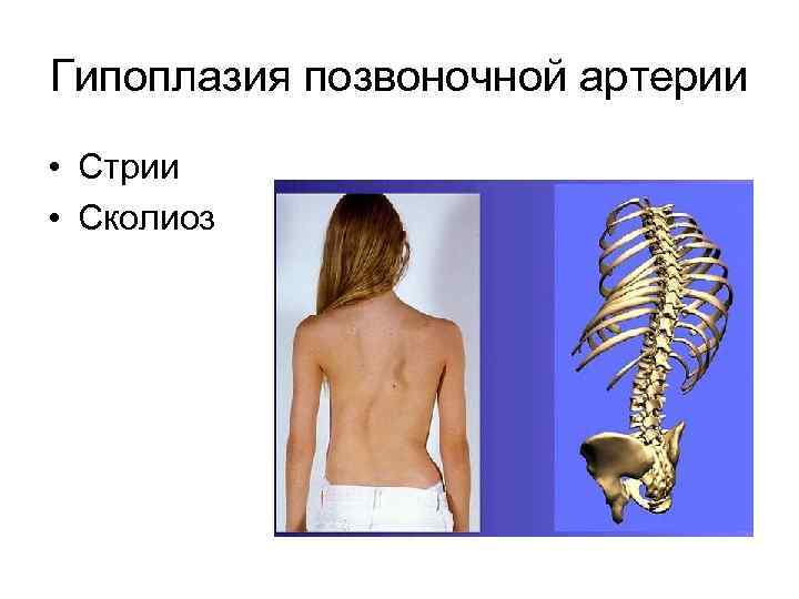 Гипоплазия позвоночной артерии • Стрии • Сколиоз 