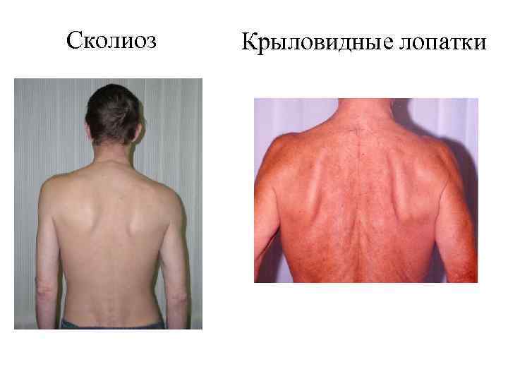 Сколиоз Крыловидные лопатки 