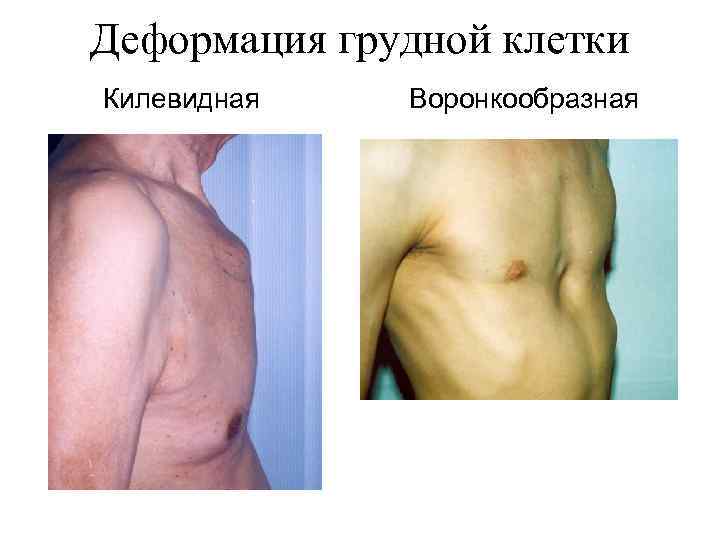 Деформация грудной клетки Килевидная Воронкообразная 