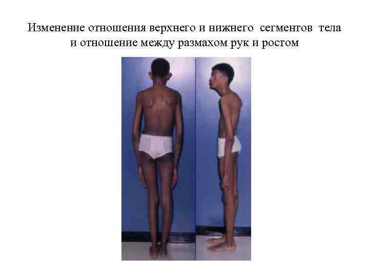Изменение отношения верхнего и нижнего сегментов тела и отношение между размахом рук и ростом