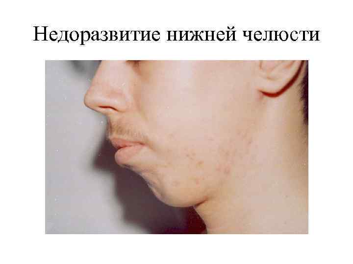 Недоразвитие нижней челюсти 