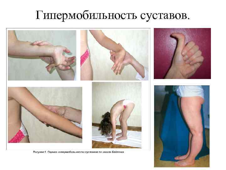 Гипермобильность суставов. 