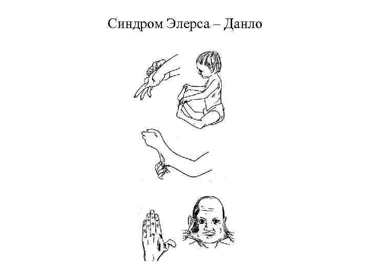 Синдром Элерса – Данло 