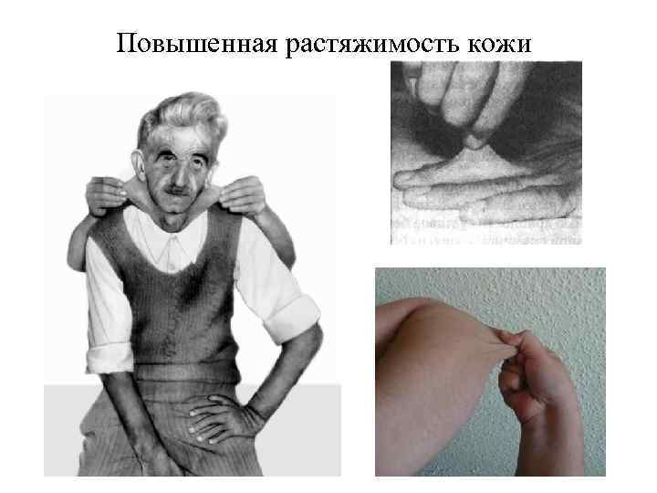 Повышенная растяжимость кожи 