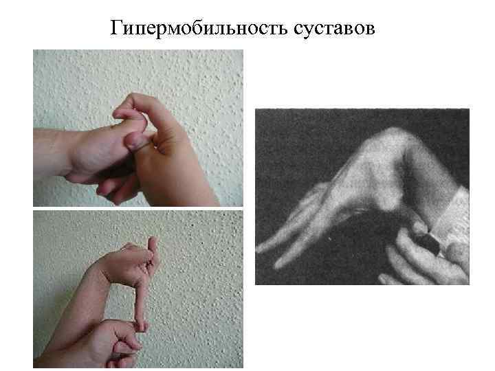Гипермобильность суставов 