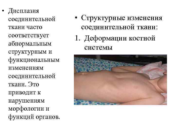  • Дисплазия соединительной ткани часто соответствует абнормальным структурным и функциональным изменениям соединительной ткани.