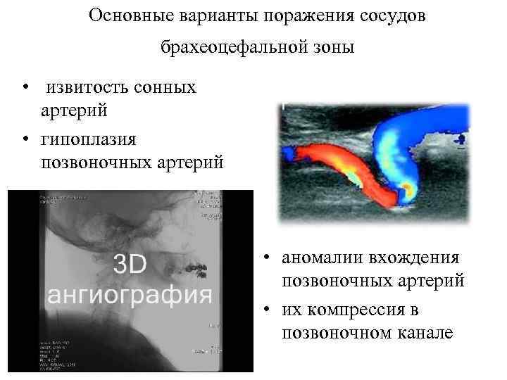Основные варианты поражения сосудов брахеоцефальной зоны • извитость сонных артерий • гипоплазия позвоночных артерий