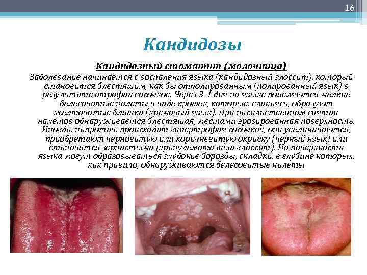 16 Кандидозы Кандидозный стоматит (молочница) Заболевание начинается с воспаления языка (кандидозный глоссит), который становится