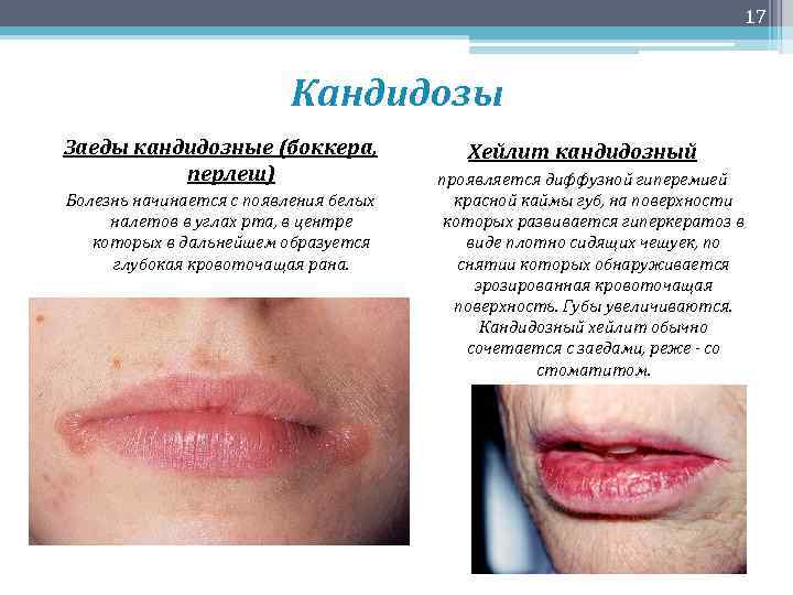 17 Кандидозы Заеды кандидозные (боккера, перлеш) Болезнь начинается с появления белых налетов в углах