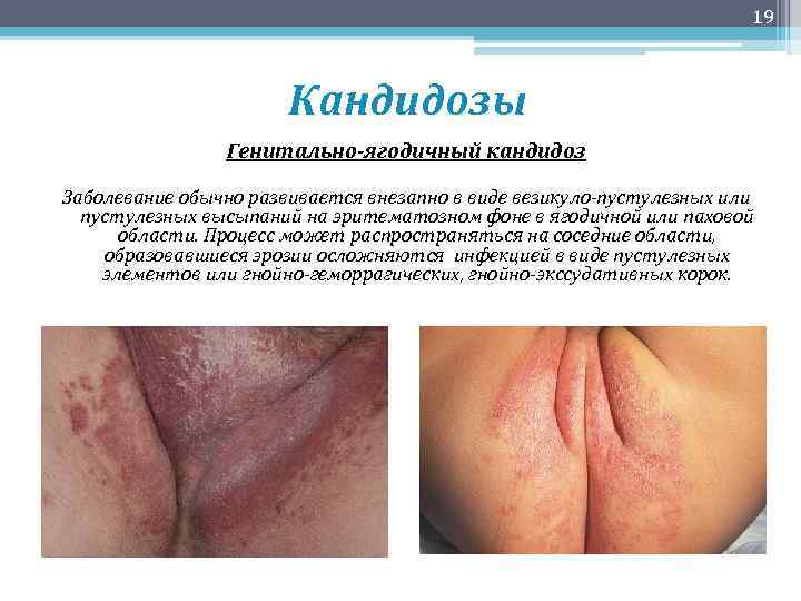 19 Кандидозы Генитально-ягодичный кандидоз Заболевание обычно развивается внезапно в виде везикуло-пустулезных или пустулезных высыпаний