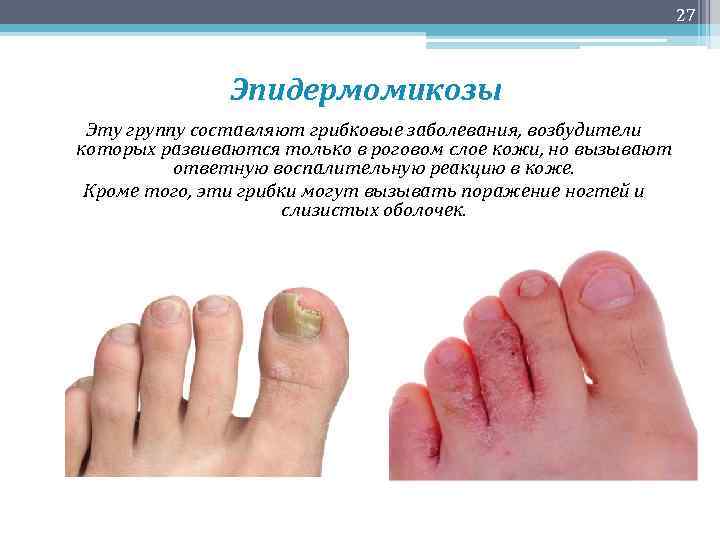 27 Эпидермомикозы Эту группу составляют грибковые заболевания, возбудители которых развиваются только в роговом слое