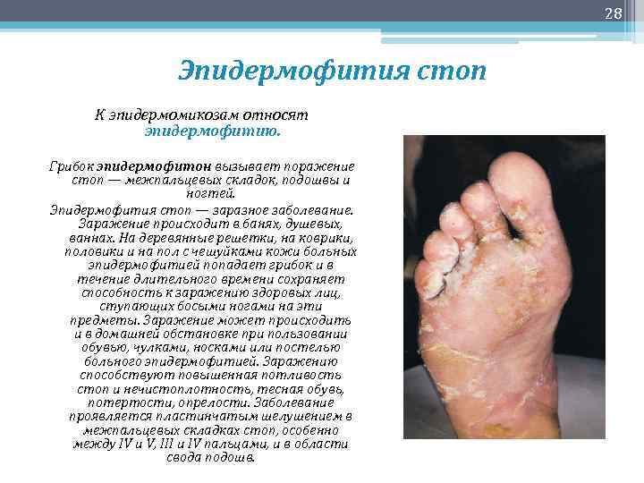 28 Эпидермофития стоп К эпидермомикозам относят эпидермофитию. Грибок эпидермофитон вызывает поражение стоп — межпальцевых
