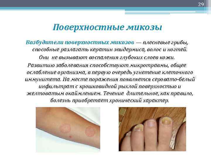 29 Поверхностные микозы Возбудители поверхностных микозов — плесневые грибы, способные разлагать кератин эпидермиса, волос