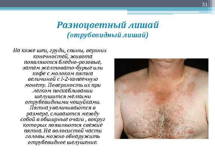 31 Разноцветный лишай (отрубевидный лишай) На коже шеи, груди, спины, верхних конечностей, живота появляются