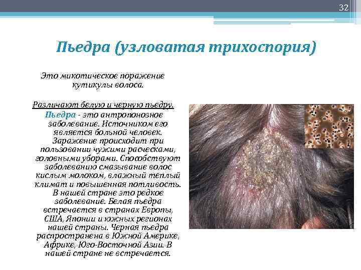 32 Пьедра (узловатая трихоспория) Это микотическое поражение кутикулы волоса. Различают белую и черную пьедру.