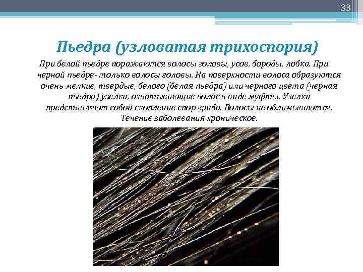 33 Пьедра (узловатая трихоспория) При белой пьедре поражаются волосы головы, усов, бороды, лобка. При