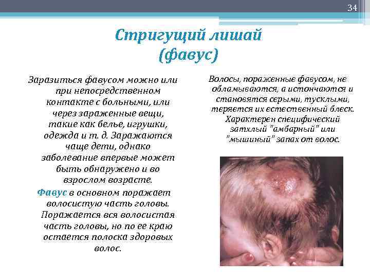 34 Стригущий лишай (фавус) Заразиться фавусом можно или при непосредственном контакте с больными, или