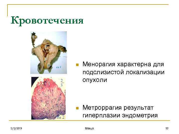 Кровотечения n n 2/2/2018 Менорагия характерна для подслизистой локализации опухоли Метроррагия результат гиперплазии эндометрия
