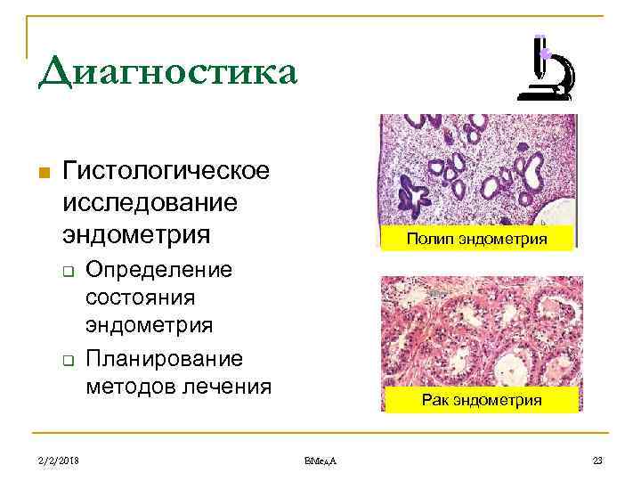 Диагностика n Гистологическое исследование эндометрия q q 2/2/2018 Полип эндометрия Определение состояния эндометрия Планирование