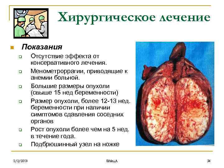 Хирургическое лечение n Показания q q q 2/2/2018 Отсутствие эффекта от консервативного лечения. Менометроррагии,