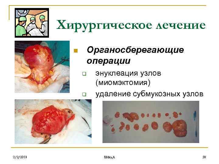 Хирургическое лечение Органосберегающие операции n q q 2/2/2018 энуклеация узлов (миомэктомия) удаление субмукозных узлов