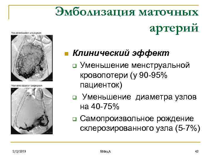 Эмболизация маточных артерий n Клинический эффект q q q 2/2/2018 Уменьшение менструальной кровопотери (у