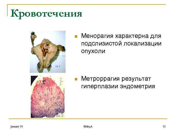 Кровотечения n n January 18 Менорагия характерна для подслизистой локализации опухоли Метроррагия результат гиперплазии
